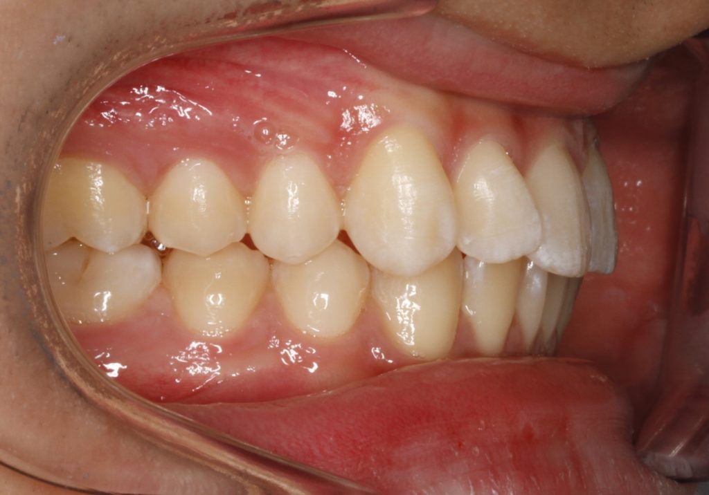 Enfermedades de la encía Sevilla