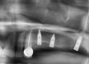 Implantes dentales