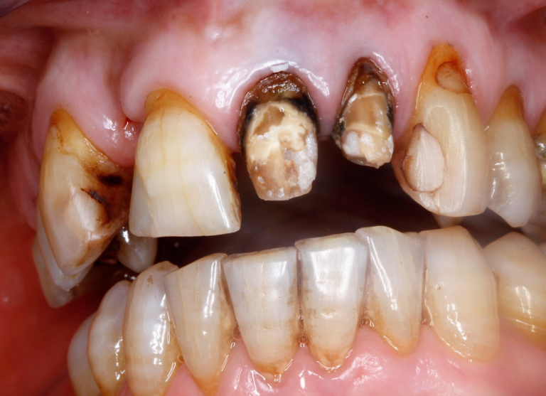 Rehabilitación oral