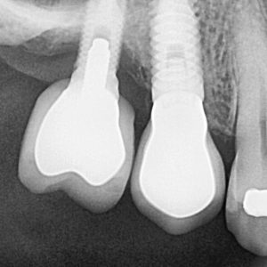 IS20240925_111217_0127_00003563 Implantología oral