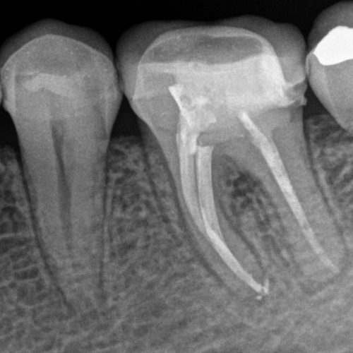 Tratamiento de conductos en Sevilla